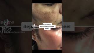 cosmelan Depigmenration Peel shorts pigmentation pigmentationsolution [upl. by Camus951]