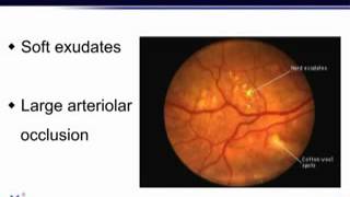 diabetic retinopathy  Dr Kannan [upl. by Bat]