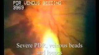 VideoDocumentation of Retinal Diseases [upl. by Salene180]