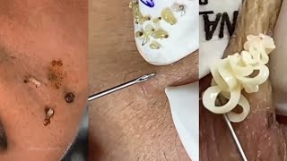 Satisfying Blackhead Extraction Compilation  Deep Pore Cleansing and Acne Treatment [upl. by Legyn926]