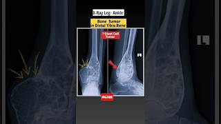 Radiology positioning and projections  x ray ankle joint trending viral shorts [upl. by Gary83]