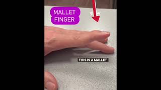 how to fix mallet finger injury mallets physio physicalfitness exercise rehab pain [upl. by Dadivitan]