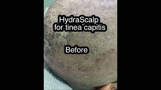 HydraScalp for tinea capitisseborrheic dermatitis [upl. by Laefar]