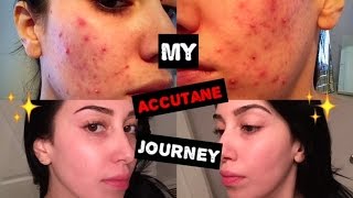 My Accutane Journey  6 Months in 5 Minutes [upl. by Sil696]