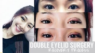 NonInvasive Double Eyelid Procedure  Recovery Process  FATFOAL [upl. by Ashwell]