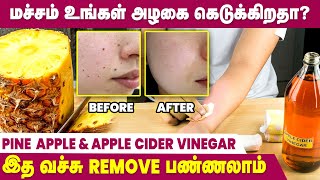 How to Remove Moles Naturally  DIY Mole Removal Pack  IBC Mangai [upl. by Ahselak]