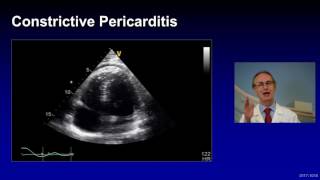 Treatment of Complicated Pericarditis [upl. by Adnovad975]