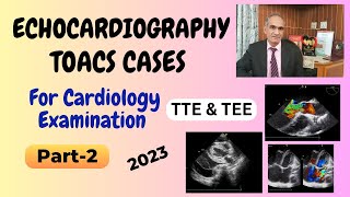 ECHOCARDIOGRAPHY TOACS CASES FOR CARDIOLOGY EXAMINATION PART 2 URDU  HINDI [upl. by Ryder353]