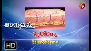 Aarogyamastu  Scleroderma  29th June 2017  ఆరోగ్యమస్తు [upl. by Retsel366]