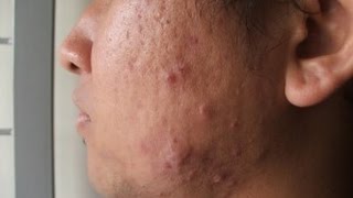 WHAT FOODS CAUSE ACNE [upl. by Akselaw]