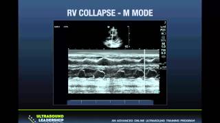 Ultrasound Podcast  PERICARDIAL TAMPONADE LEARN THIS KNOW THIS [upl. by Kerby611]