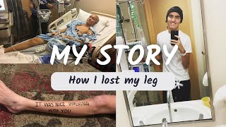 How I Lost My Leg  My Cancer Story [upl. by Ecniuq]