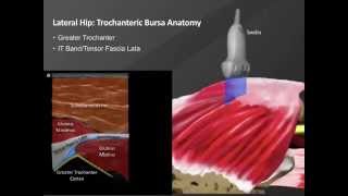 IntraArticular Injection of the Sacroiliac Joint Under Fluoroscopic Guidance [upl. by Annaehr185]