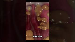 helicobacter pylori infection [upl. by Forkey842]