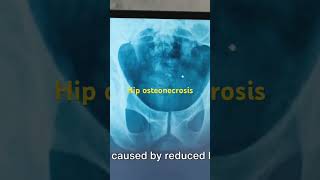 Hip Osteonecrosis [upl. by Plumbo]