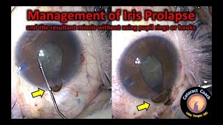 How to fix Iris Prolapse in Cataract Surgery [upl. by Yerac]