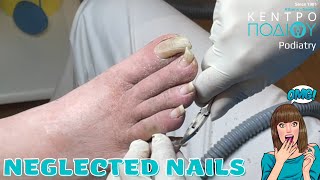 Neglected nails feet κεντροποδιου foot footcare podologos orthotics calluses podiatrist [upl. by Yentyrb]