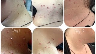 Skin tag removal  part 1 application [upl. by Anima583]