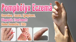 Pompholyx eczema causes symptoms diagnosis treatment home remedies FAQ  Dyshidrotic eczema [upl. by Yggep128]