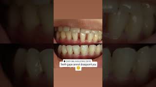 Teeth gaps treatment draparnasinghal teethgap cosmetic [upl. by Anillek]