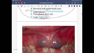 Cystic lesion lec3 5th Stage [upl. by Ybot346]