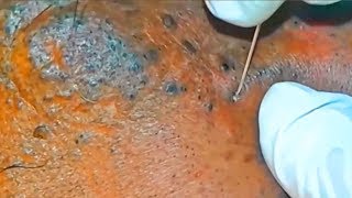 Mangos Nevus Comedonicus Spreading Blackheads [upl. by Wallinga]