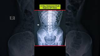 Digital Abdomen Xray Supine AP View shorts [upl. by Hepsoj]