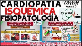 CARDIOPATÍA ISQUÉMICA FISIOPATOLOGÍA  GuiaMed [upl. by Orelee297]