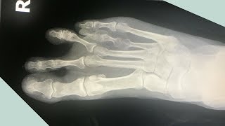 What the Heck Is It  Short Toe Syndrome [upl. by Anitsirhc77]