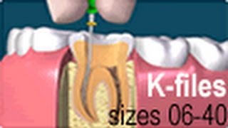 Dental Endo Hand Use Root Canal K Files [upl. by Martin]