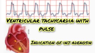 ventricular tachycardia with pulse [upl. by Llimaj]