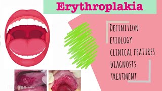 Erythroplakia  precancerous lesion  cause I clinical features I diagnosis I treatnent [upl. by Britteny]