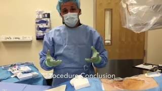 Spinal Cord Stimulator Trial Performed By Eduard Vaynberg MD [upl. by Lennon]