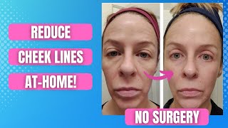 Smooth and Youthful Minimize MidCheek Lines With These Effective AtHome Remedies [upl. by Dena295]