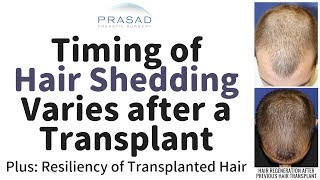 Why Timing of Hair Shedding after a Transplant can Vary and the Resilience of Transplanted Hair [upl. by Carrissa]