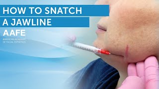 Jawline Filler Tutorial [upl. by O'Donoghue]