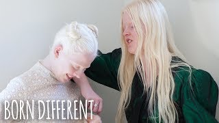 The Besties With Albinism  BORN DIFFERENT [upl. by Maximilien]