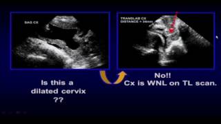 Imaging the Cervix in Pregnancy Helpful Hints [upl. by Ahl]