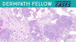 Dermpath Fellow Slide Session Kaposiform hemangioendothelioma plexiform fibrohistiocytic tumor etc [upl. by Nehtiek]