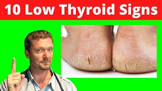 10 Skin Signs of LOW THYROID Skin Signs of Hypothyroidism 2024 [upl. by Levania]