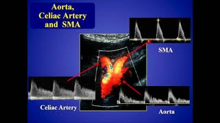 Mesenteric Ischemia [upl. by Leatri181]