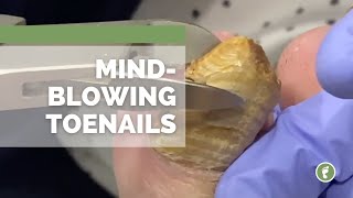 MIND🤯BLOWING TOENAILS [upl. by Liahus]