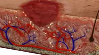 CICATRICES QUELOIDES ▶ Causas prevención y tratamientos ✅ [upl. by Dahle]