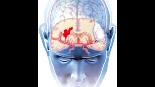 Tratamiento de aneurismas cerebrales ACV [upl. by Leaw]