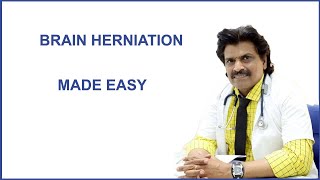 BRAIN HERNIATION MADE EASY [upl. by Filomena338]