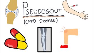 Pseudogout Calcium Pyrophosphate Disease  Simple and easy to understand [upl. by Minetta]