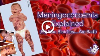 Meningococcemia Explained [upl. by Touber]