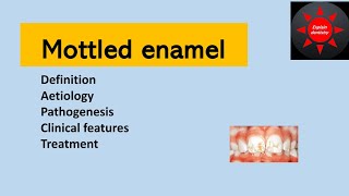 Mottled enamel  Oral pathology  Enamel hypoplasia due to fluoride [upl. by Rick]