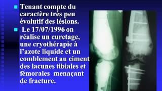 Hémangioendothéliome épithélioïde multifocal du membre inférieur [upl. by Einwahr338]