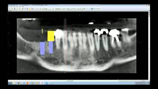 Future tooth position  the key to restorativedriven virtual implant planning 14 [upl. by Mersey]